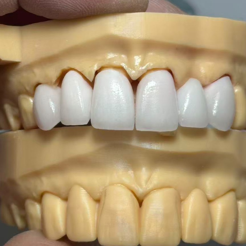 Anterior restorative work shown on a working model