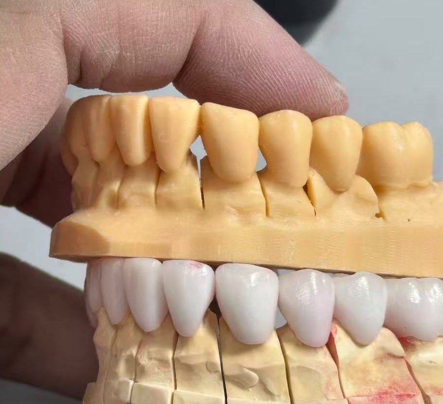 Lateral view of multi-unit restorative work on a working model