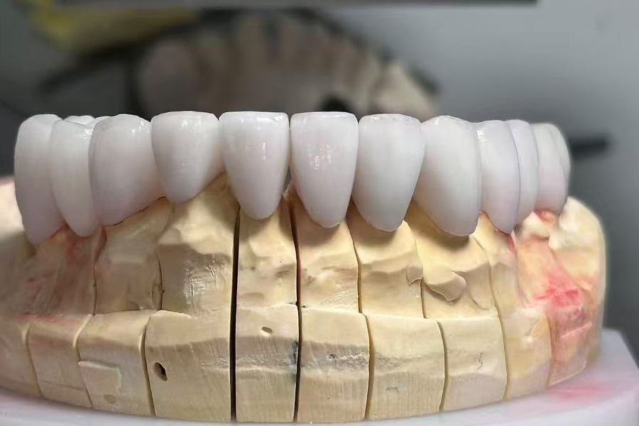 Lower-arch restorative work shown on a laboratory model