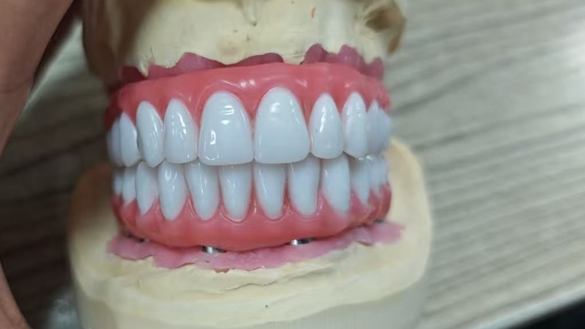 Full-arch restorative work shown on a laboratory model