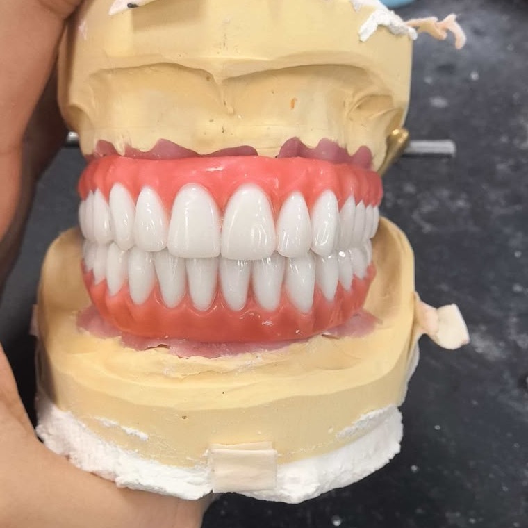 Full-arch restorative work shown on a laboratory model