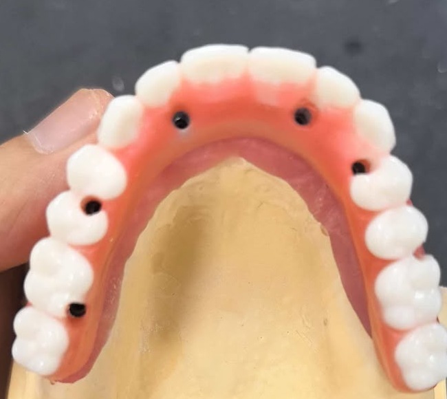 Occlusal view of full-arch restorative work on a working model