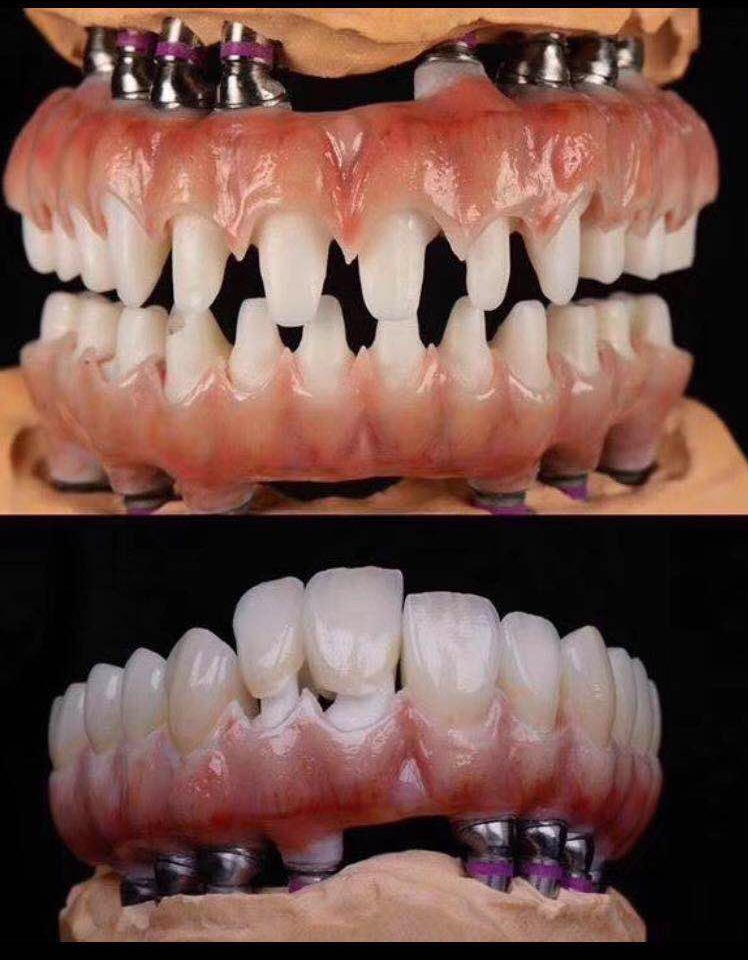 Two technical views of full-arch restorative work