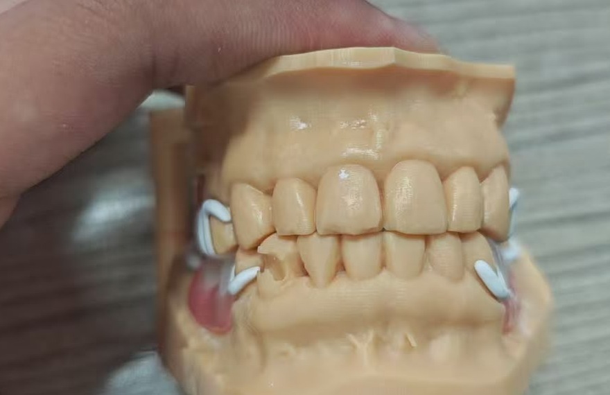 Removable framework shown from the frontal view on an articulated model