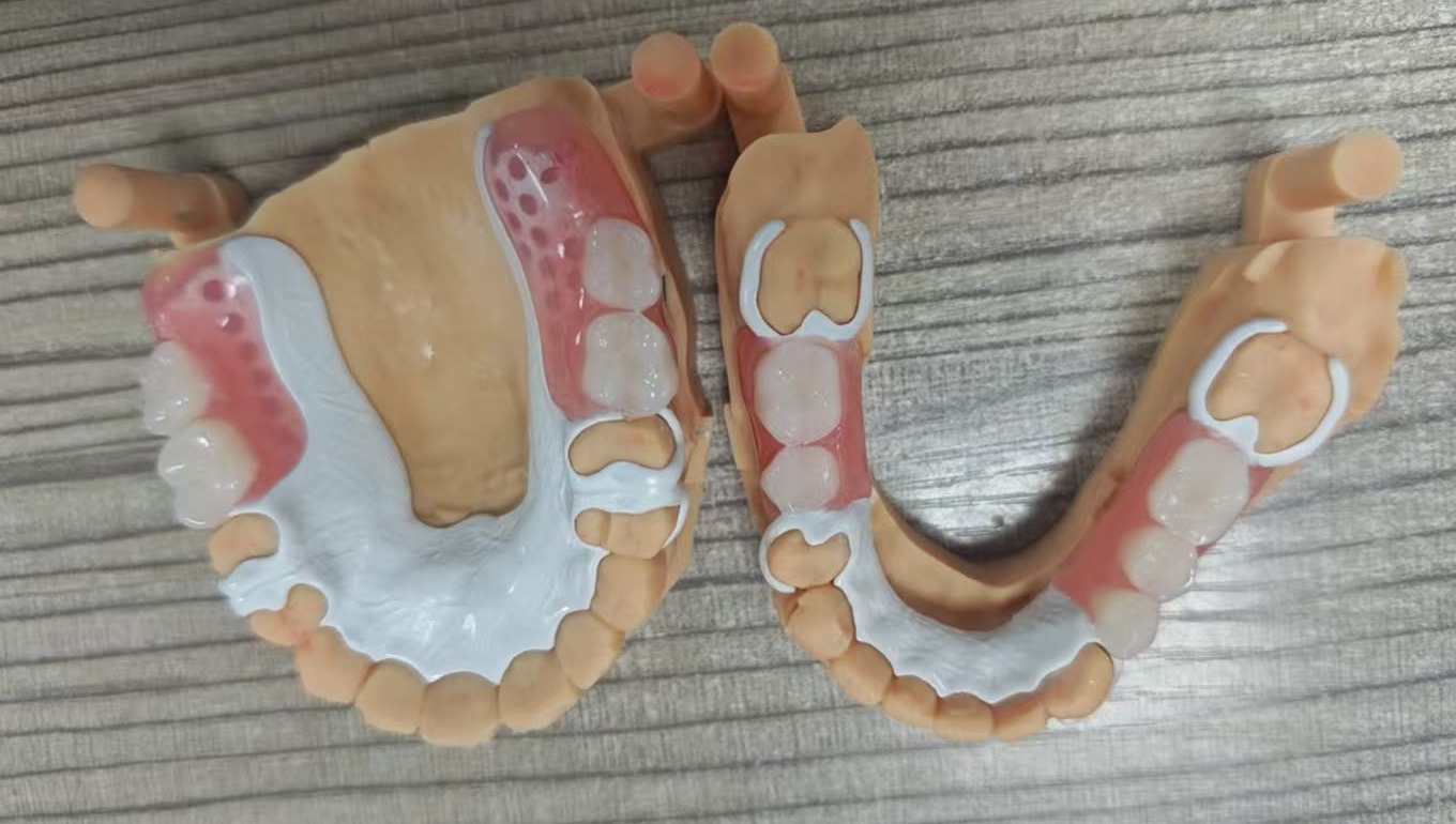 Removable frameworks shown from the occlusal view on working models